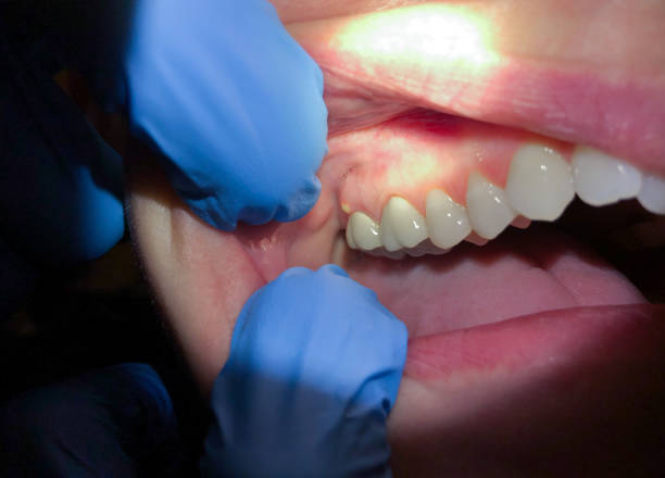 Best Knocked-Out Tooth Emergency  in Saybrook On The Lake, OH